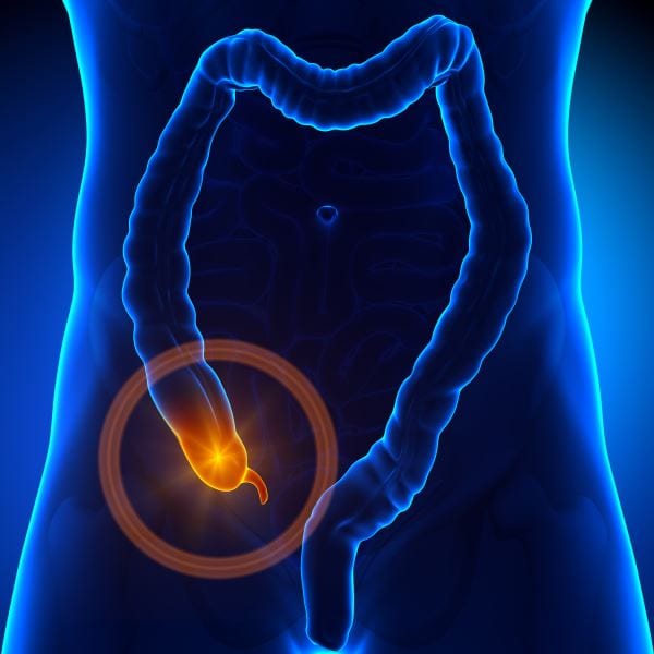 appendix-cancer