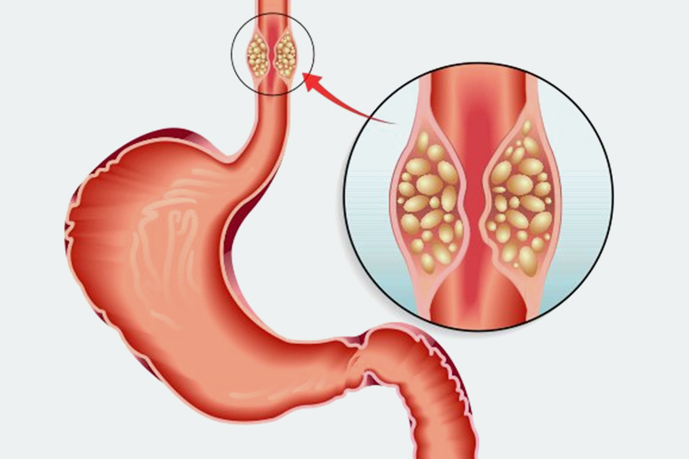 esophageal-cancer