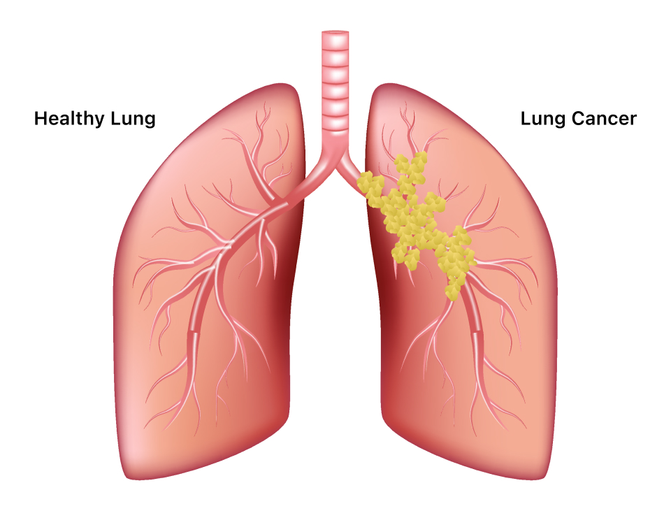 lung-cancer