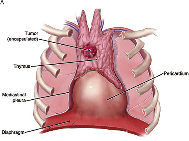 thymic-tumour