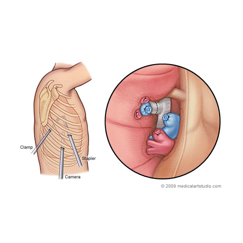 vats-lobectomy